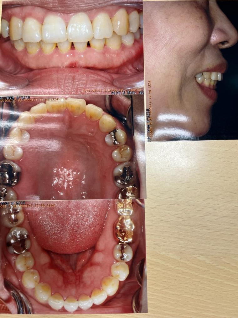 噛み合わせが悪く奥歯が痛く口が開かない50代の女性をインビザラインで治した症例