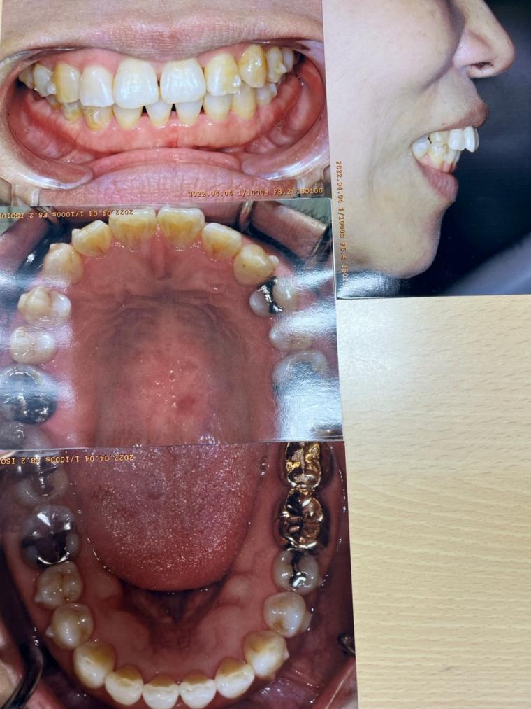 噛み合わせが悪く奥歯が痛く口が開かない50代の女性をインビザラインで治した症例