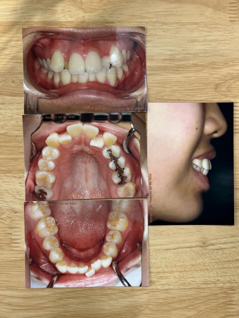 口を開けて笑えない。前歯のガタガタと八重歯を非抜歯インビザラインで治した15歳女性
