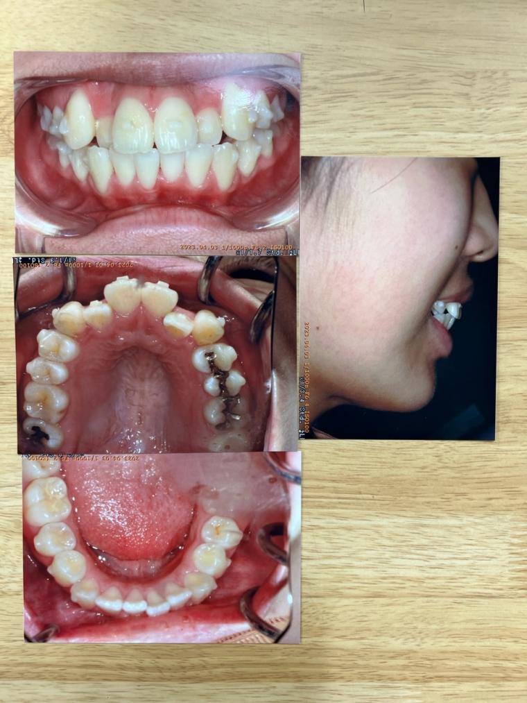 口を開けて笑えない。前歯のガタガタと八重歯を非抜歯インビザラインで治した15歳女性