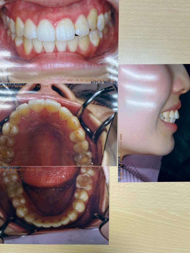 八重歯と上の前歯が出ていること、下顎がズレて口が開けにくいこと、下の前歯がガタガタを非抜歯インビザライン で矯正された20代女性