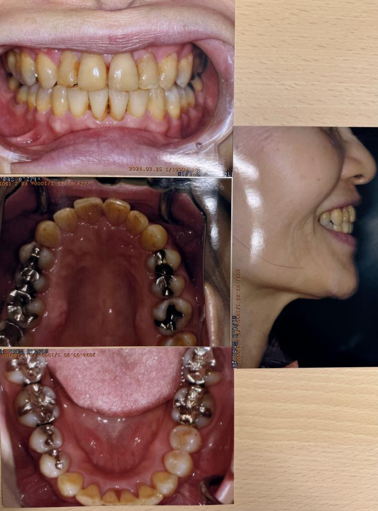 歯並びが悪く歯周病にならないように磨きやすい歯並びにインビザライン で矯正された60代の女性