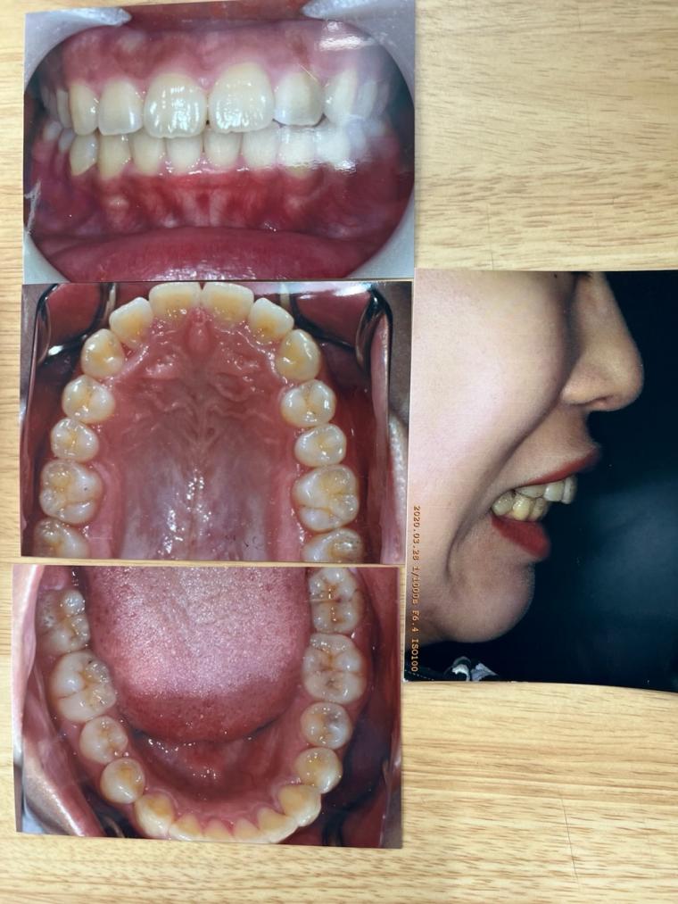 出っ歯とすきっ歯に悩む20代の女性をインビザラインで矯正した症例