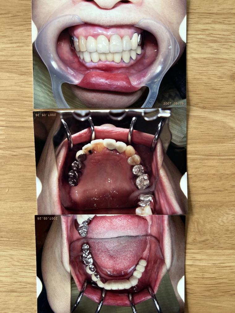 80代の女性で審美歯科(審美補綴)をされて雰囲気まで変わられた症例