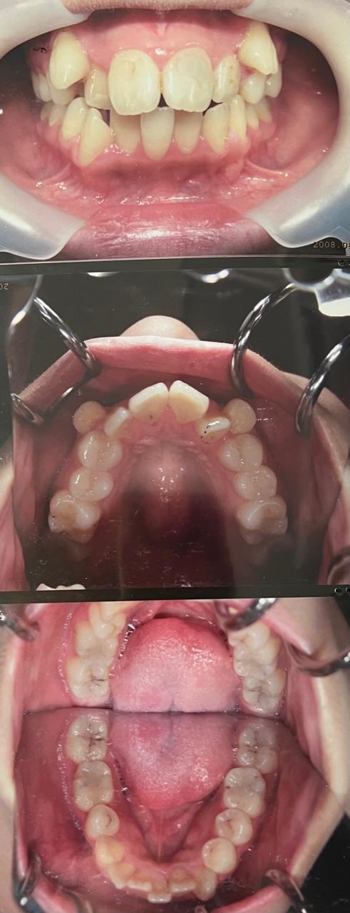 かなり短期で歯並び治す必要があり審美矯正をされた症例