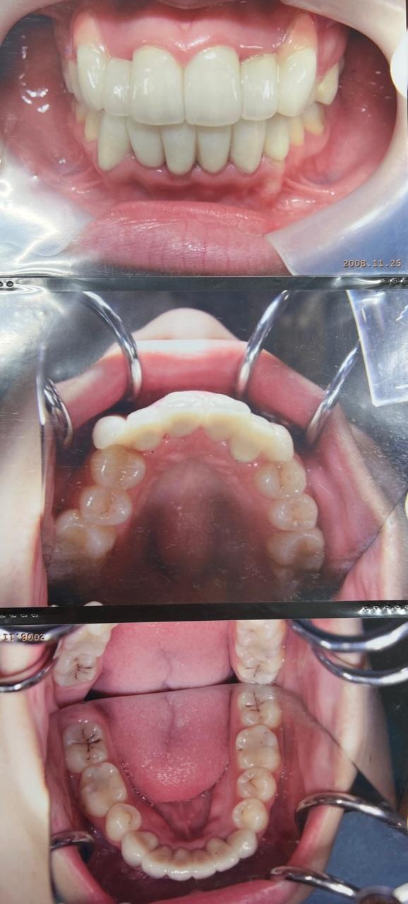 かなり短期で歯並び治す必要があり審美矯正をされた症例