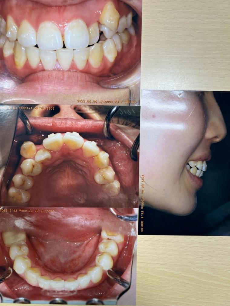 八重歯と上の前歯が出ていること、下顎がズレて口が開けにくいこと、下の前歯がガタガタを非抜歯インビザライン で矯正された20代女性