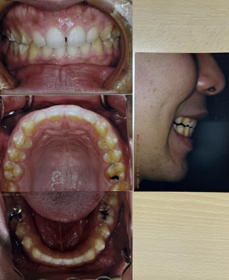 10ヶ月で、すきっ歯と噛み合わせの悪さをインビザラインで矯正した20代後半の男性