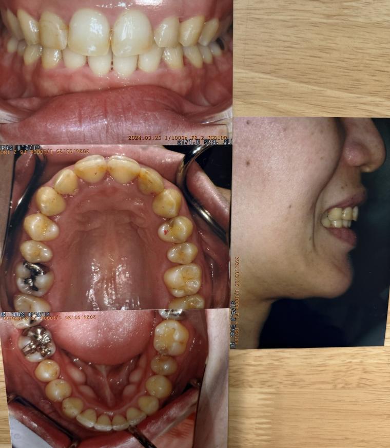 前歯の隙間や噛み合わせをインビザラインで矯正した40代女性