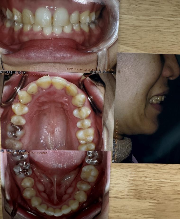 前歯の隙間や噛み合わせをインビザラインで矯正した40代女性
