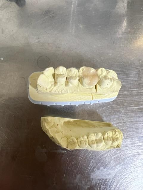 虫歯治療で詰め物つくる時、歯型を取りますが、なんで上の詰め物作るのに下の歯型まで取るんですか？