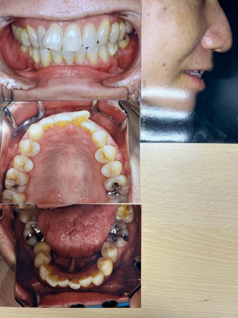 50代の女性、歯が出ているのと、ガタガタをインビザラインで矯正した症例