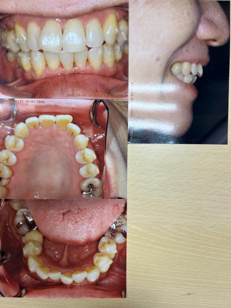 50代の女性、歯が出ているのと、ガタガタをインビザラインで矯正した症例