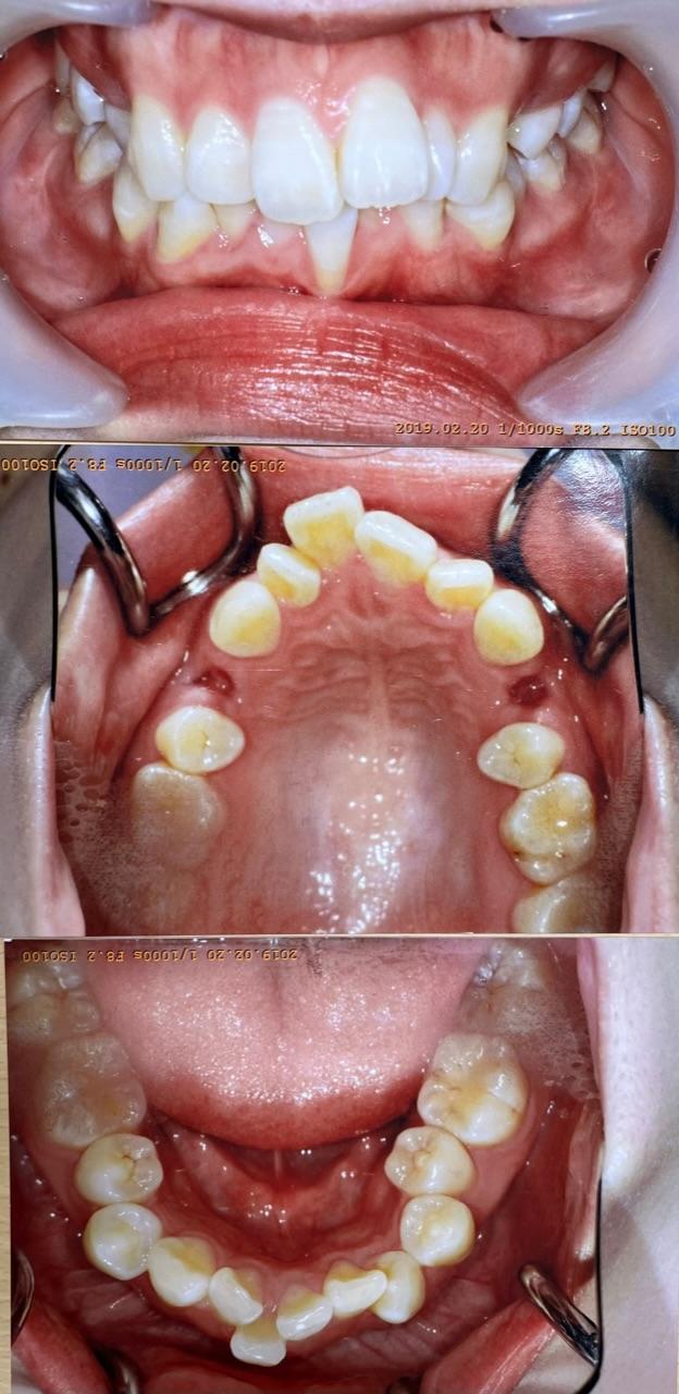 スタッフのインビザライン抜歯矯正治療症例