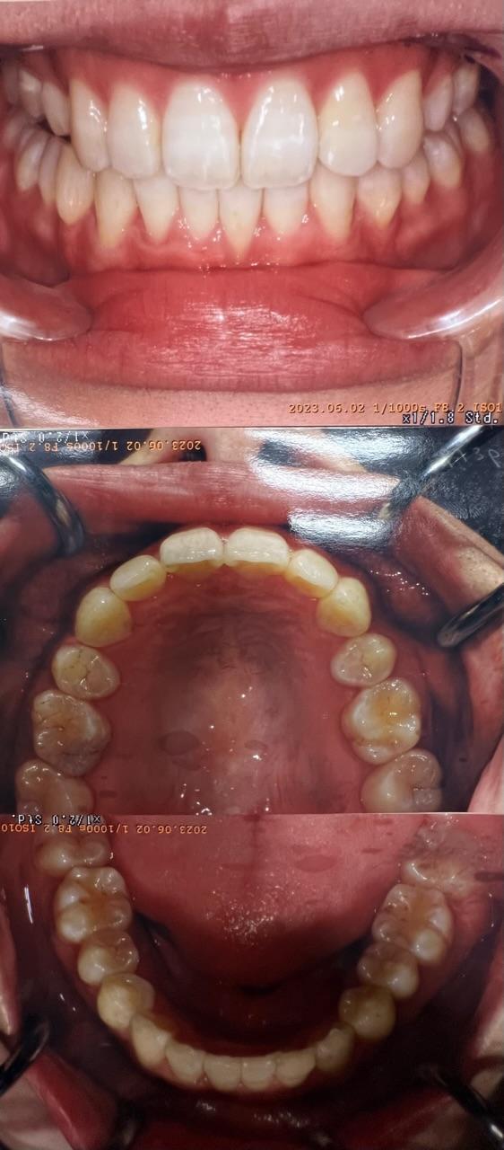 スタッフのインビザライン抜歯矯正治療症例