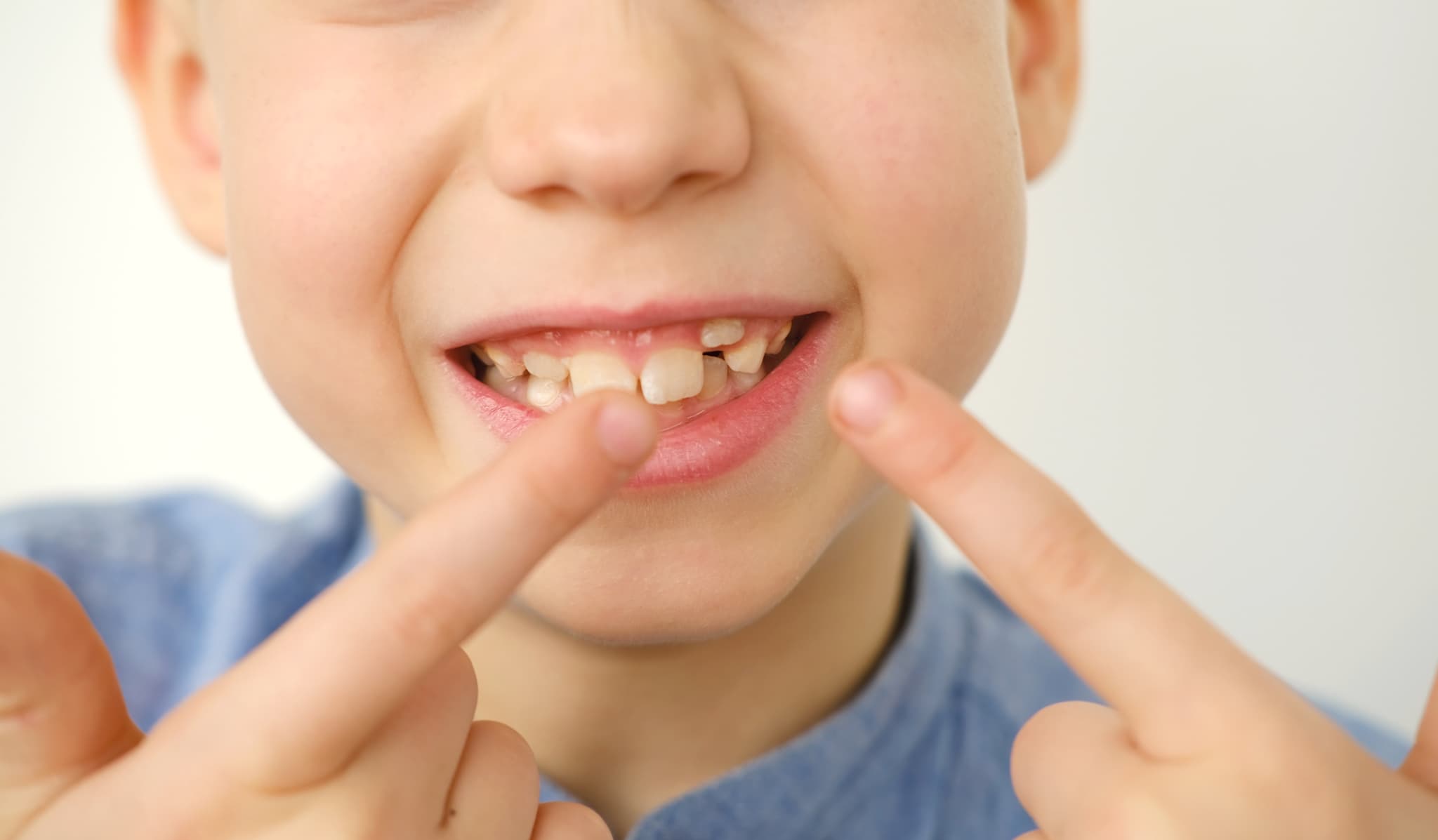 八重歯を指さす男の子